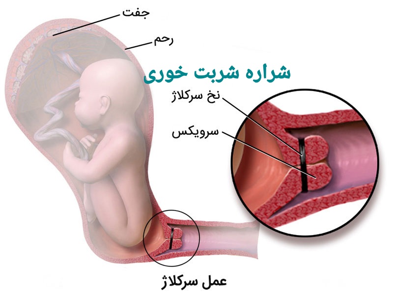 سرکلاژ بارداری