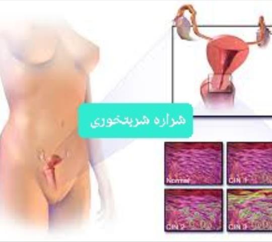 دیسپلازی گردن رحم چیست ؟خانم دکتر شراره شربتخوری