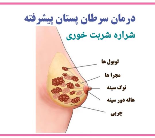 سرطان سینه