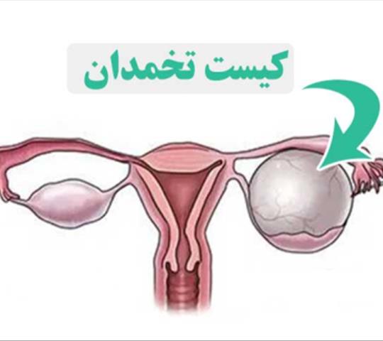 قاتل کیست تخمدان | درمان سریع کیست تخمدان ( خانگی و پزشکی )