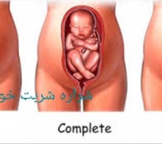 زایمان نوزاد با پا و باسن
