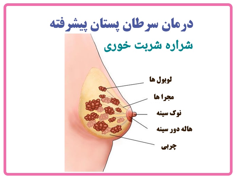 سرطان سینه