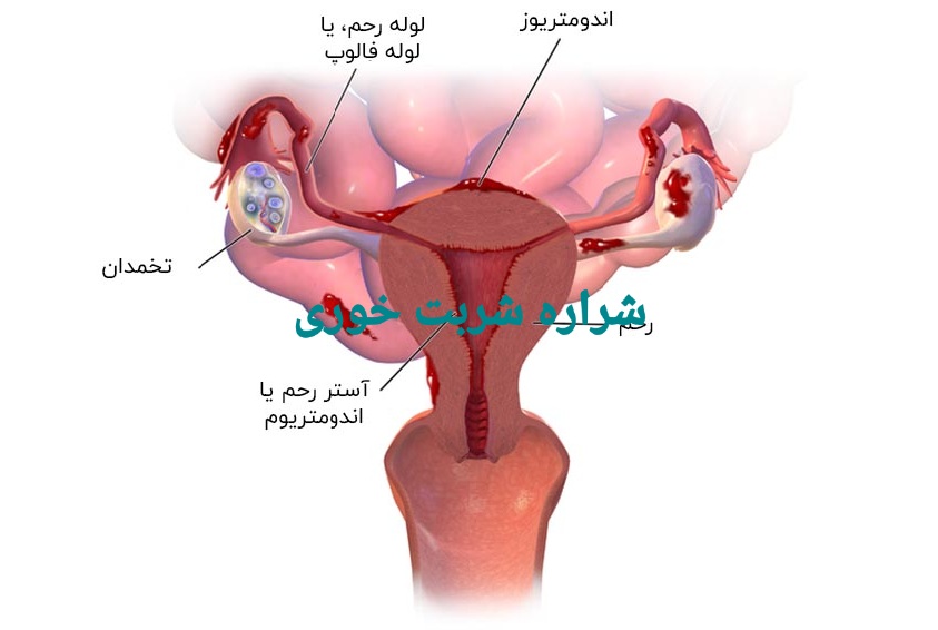 اندومتریوز