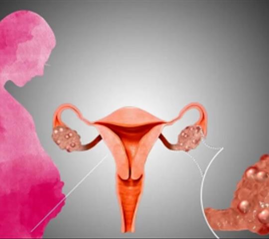 تنبلی تخمدان (PCOS) چیست؟ علائم، علل و درمان علمی سندرم تخمدان پلی‌کیستیک