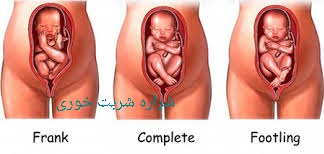 زایمان نوزاد با پا و باسن