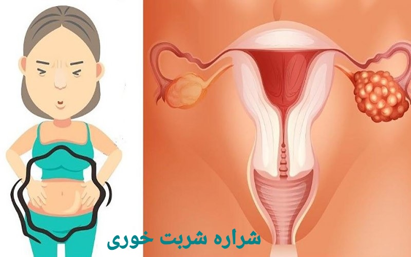 سرطان تخمدان
