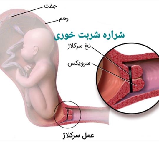 سرکلاژ بارداری
