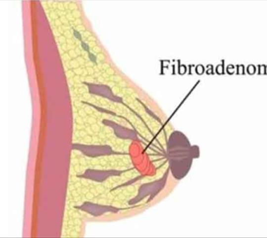 فیبروم سینه (فیبروآدنوم پستان) چیست؟ علائم، علل و روش‌های درمان