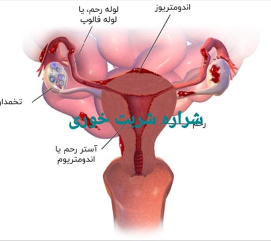 اندومتریوز